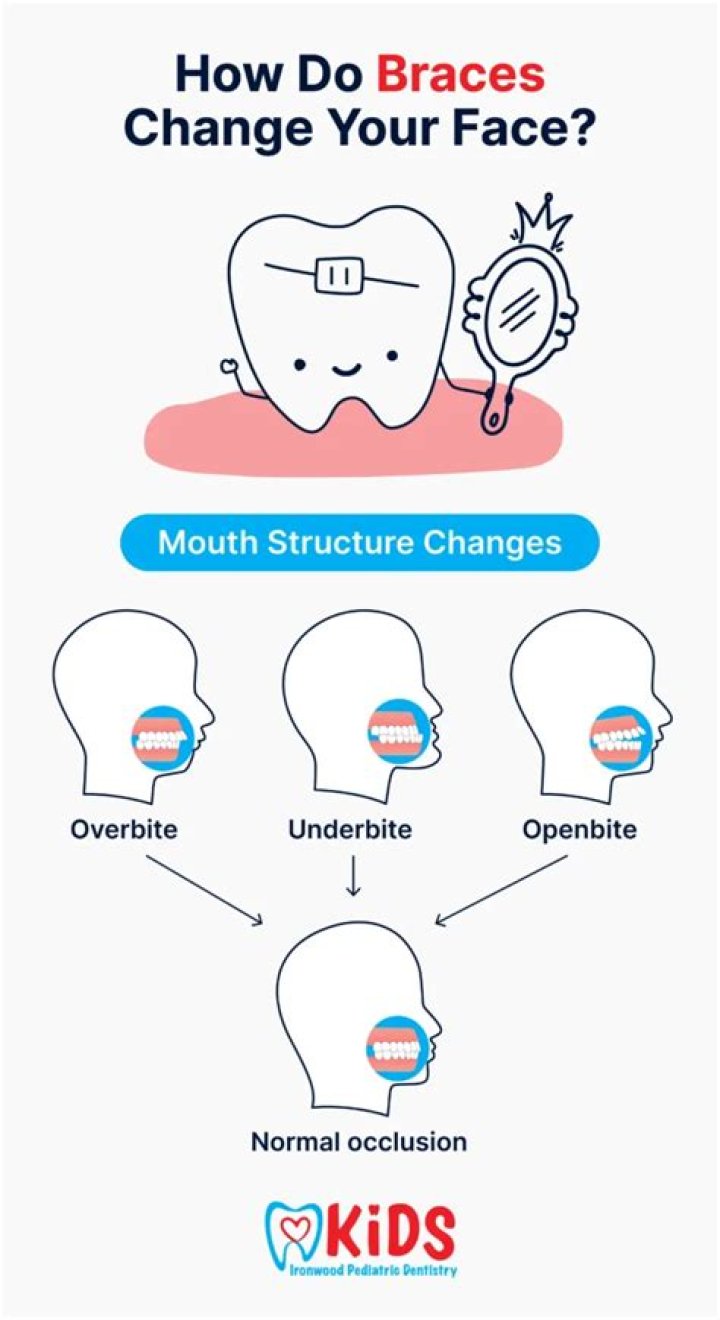 Do braces change your chin?