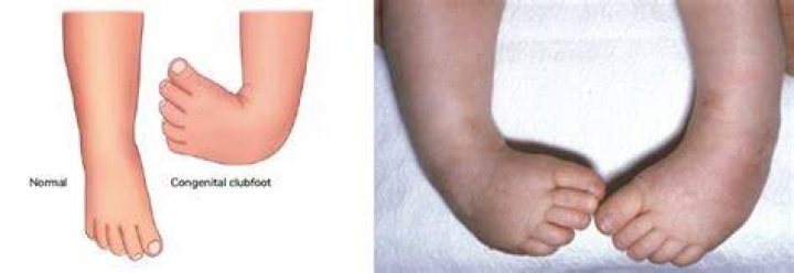Do i have club foot?