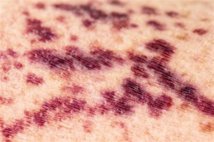 Do purpura spots bleed?