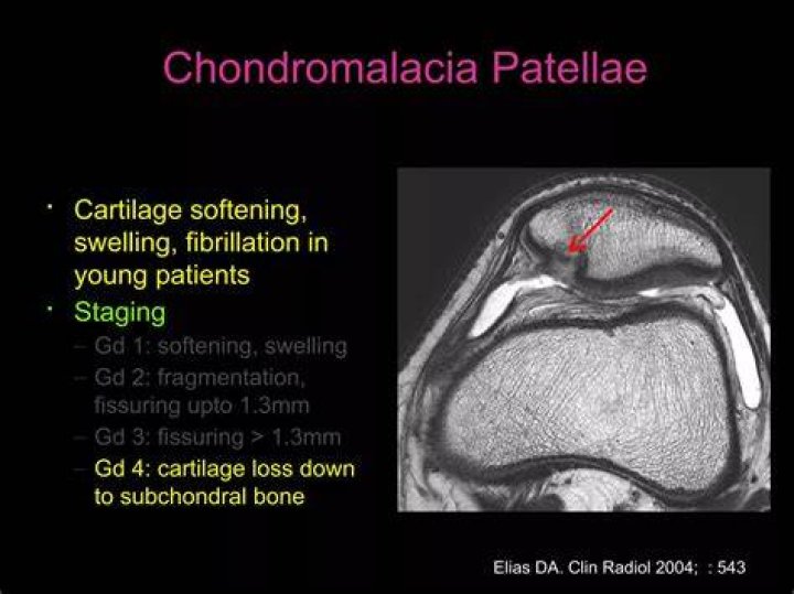 Does chondromalacia show up on mri?