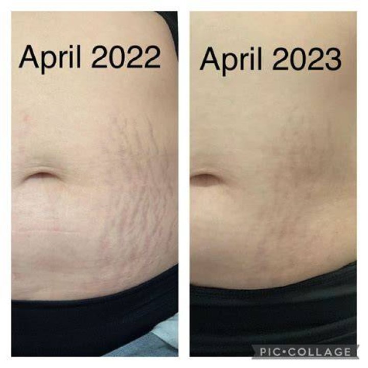 Does strialite work on old stretch marks?