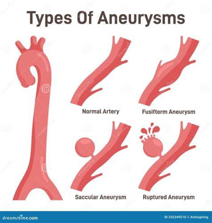 Is it spelled aneurism or aneurysm?
