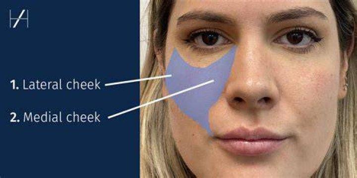 Whats a cheek lift?