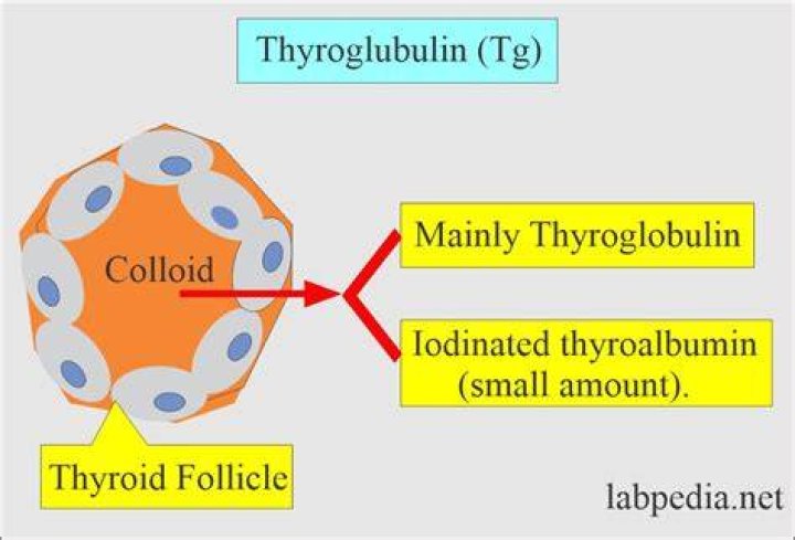 When thyroglobulin is high?