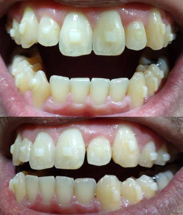 Why are my incisors yellow?